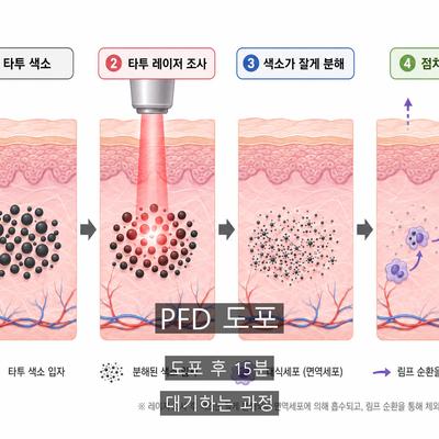 문신제거 치료기관을 고를 때 확인할 기준 3가지 이미지 5