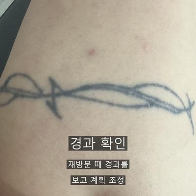 문신제거 치료기관을 고를 때 확인할 기준 3가지 이미지 8