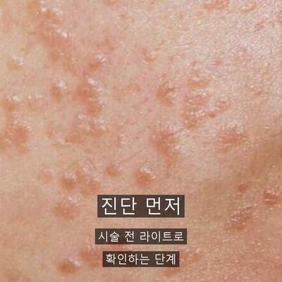 편평사마귀 치료기관을 고를 때 확인할 기준 이미지 2