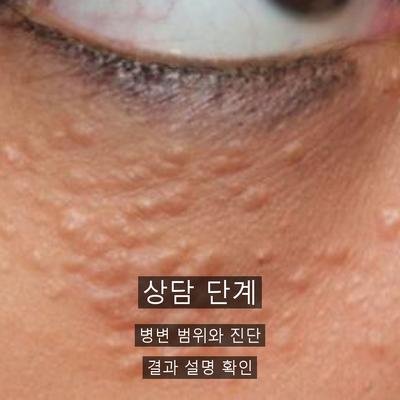 편평사마귀 치료기관을 고를 때 확인할 기준 이미지 3
