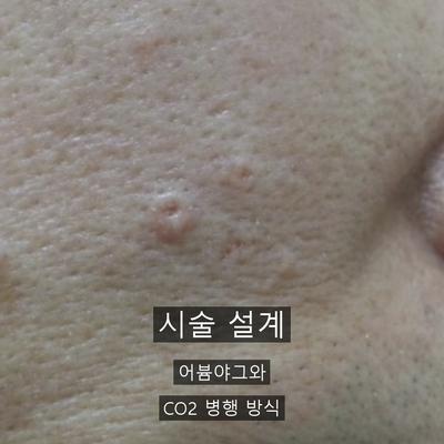 편평사마귀 치료기관을 고를 때 확인할 기준 이미지 4