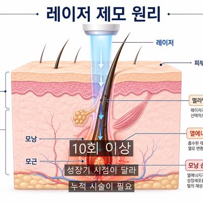 여성용제모기 써도 다시 나는 이유와 레이저제모 원리 이미지 6