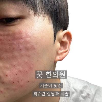 리쥬란 병원 고를 때 확인할 3가지 기준, 엠보싱과 주입 방식 이미지 9