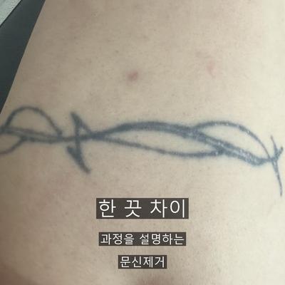 문신제거 치료기관을 고를 때 확인할 기준, 상담부터 사후 관리까지 이미지 9