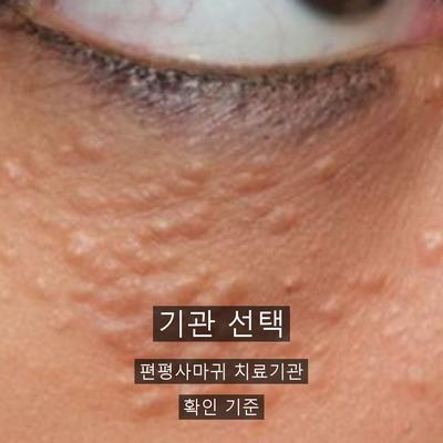편평사마귀 치료기관을 고를 때 확인할 3가지 기준 이미지 1