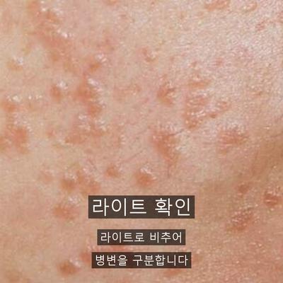 편평사마귀 치료기관을 고를 때 확인할 3가지 기준 이미지 3