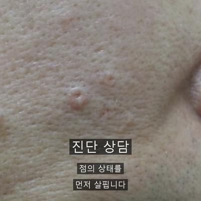 점제거 치료기관을 고를 때 확인할 기준 3가지 이미지 2