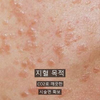 점제거 치료기관을 고를 때 확인할 기준 3가지 이미지 6