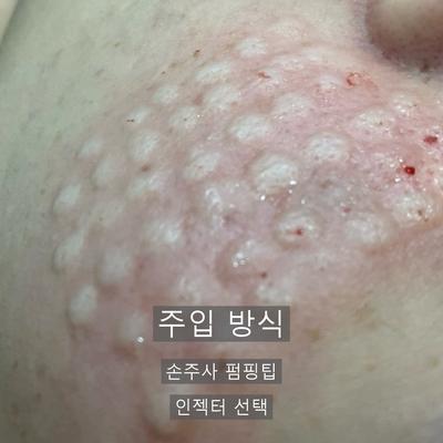 리쥬란 시술기관을 고를 때 확인할 기준, 상담·시술·관리 3단계 정리 이미지 6