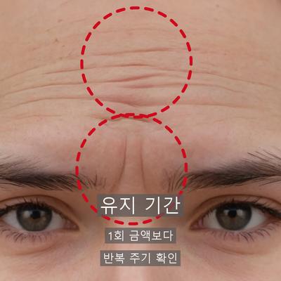 목주름필러가격 비용보다 체크해야 할 3가지 이미지 4