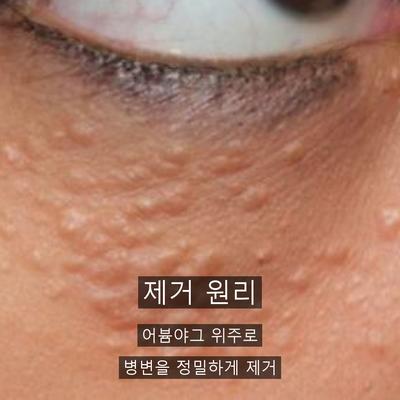 점레이저, 시술 후 재생 관리가 중요한 이유 이미지 2
