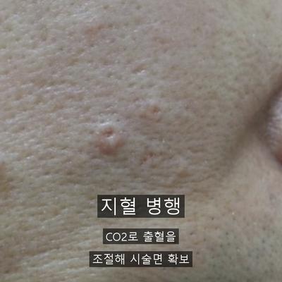 점레이저, 시술 후 재생 관리가 중요한 이유 이미지 3