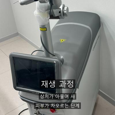 점레이저, 시술 후 재생 관리가 중요한 이유 이미지 4