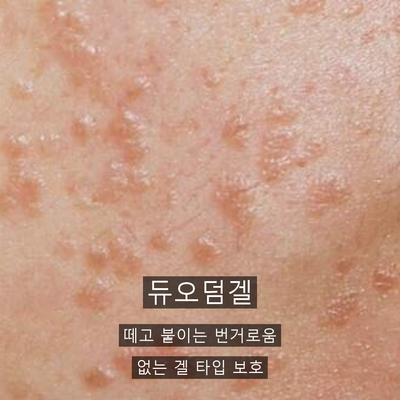 점레이저, 시술 후 재생 관리가 중요한 이유 이미지 9