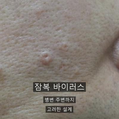 편평사마귀 치료기관을 고를 때 확인할 기준 3가지 이미지 5