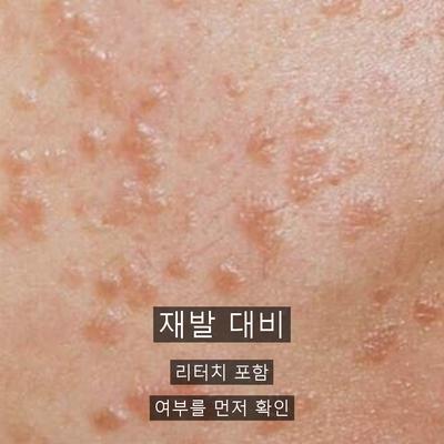 편평사마귀 치료기관을 고를 때 확인할 기준 3가지 이미지 7