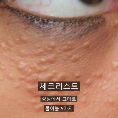 편평사마귀 치료기관을 고를 때 확인할 기준 3가지 이미지 8