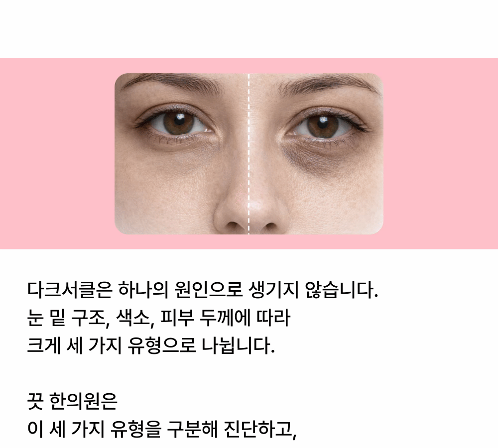 [칙칙한 눈밑을 밝히는] 다크서클 토닝 상세 이미지