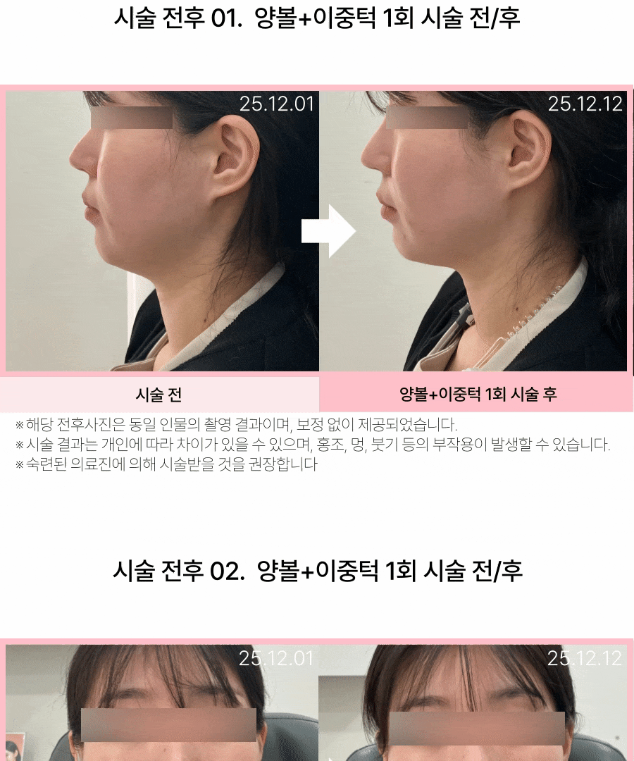  [이중턱 지방사침]지방 흡입 효과를 비수술로!