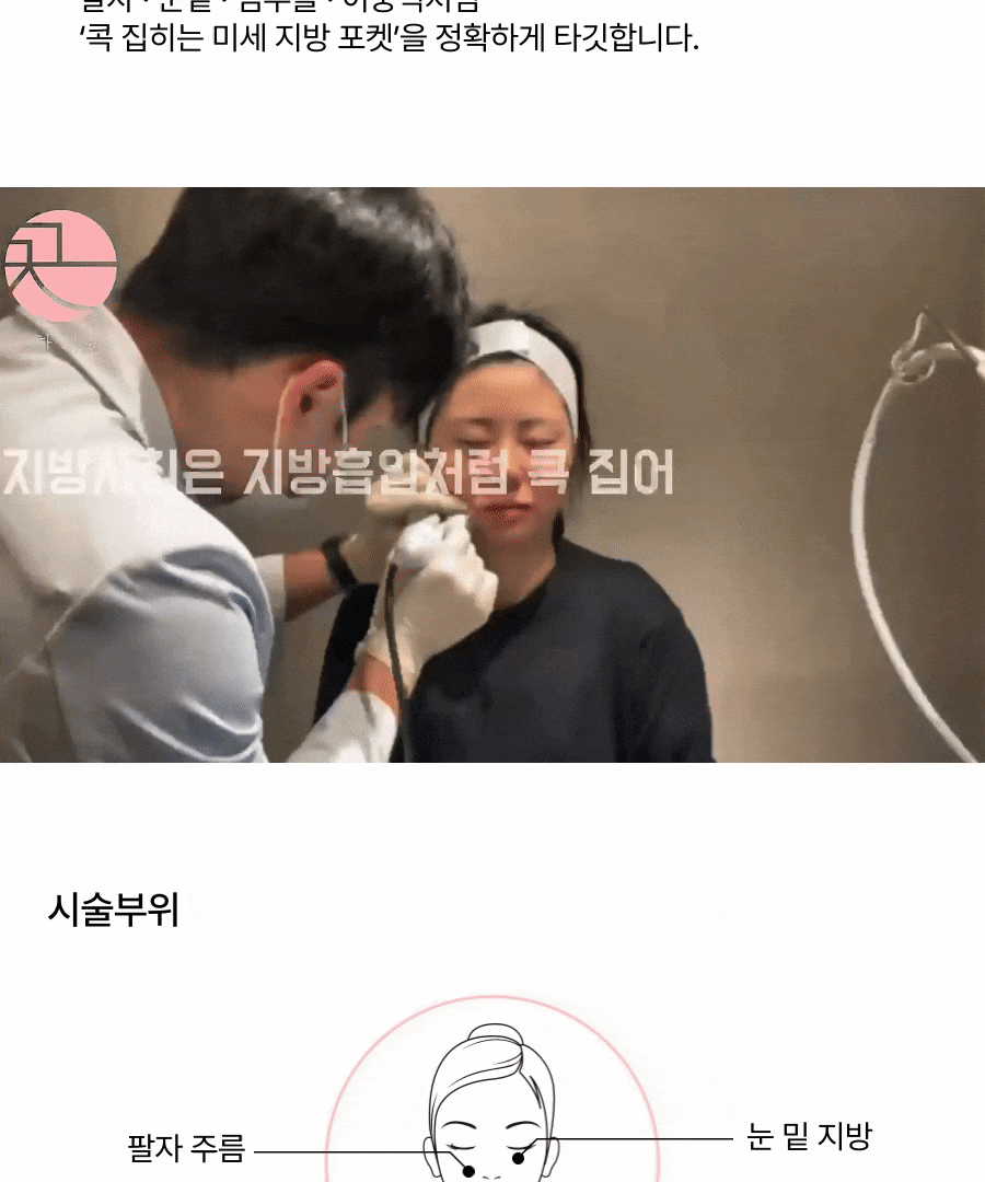 [심부볼(불독살) 지방사침]불독살 지방 제거를 비수술로