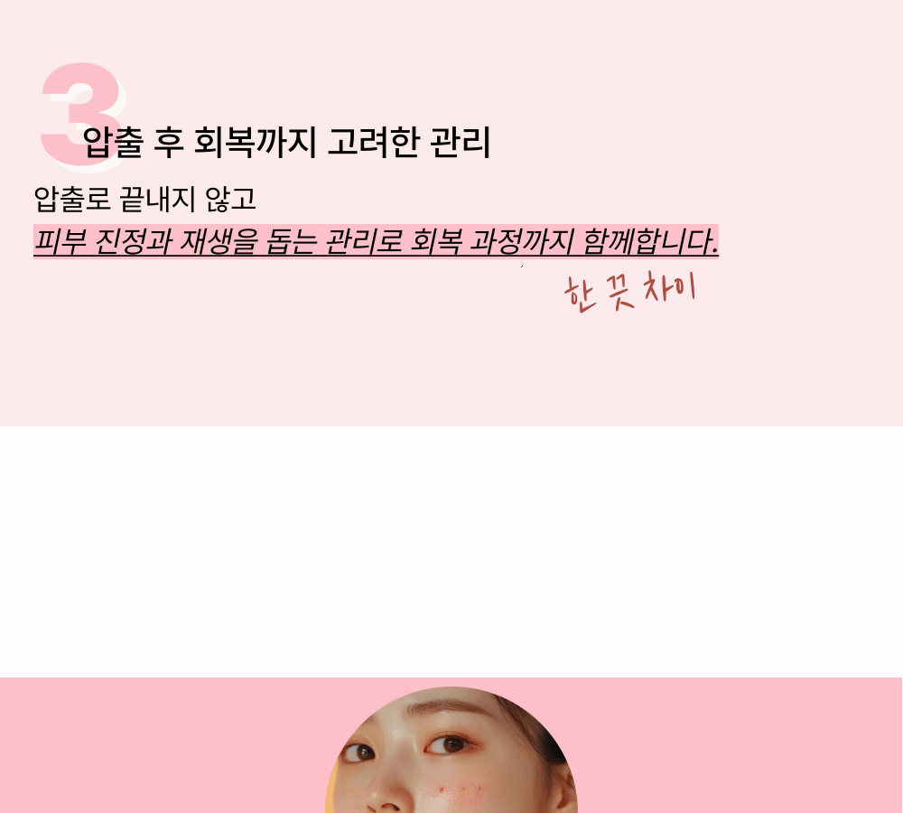 [여드름 관리의 기본] 여드름 압출