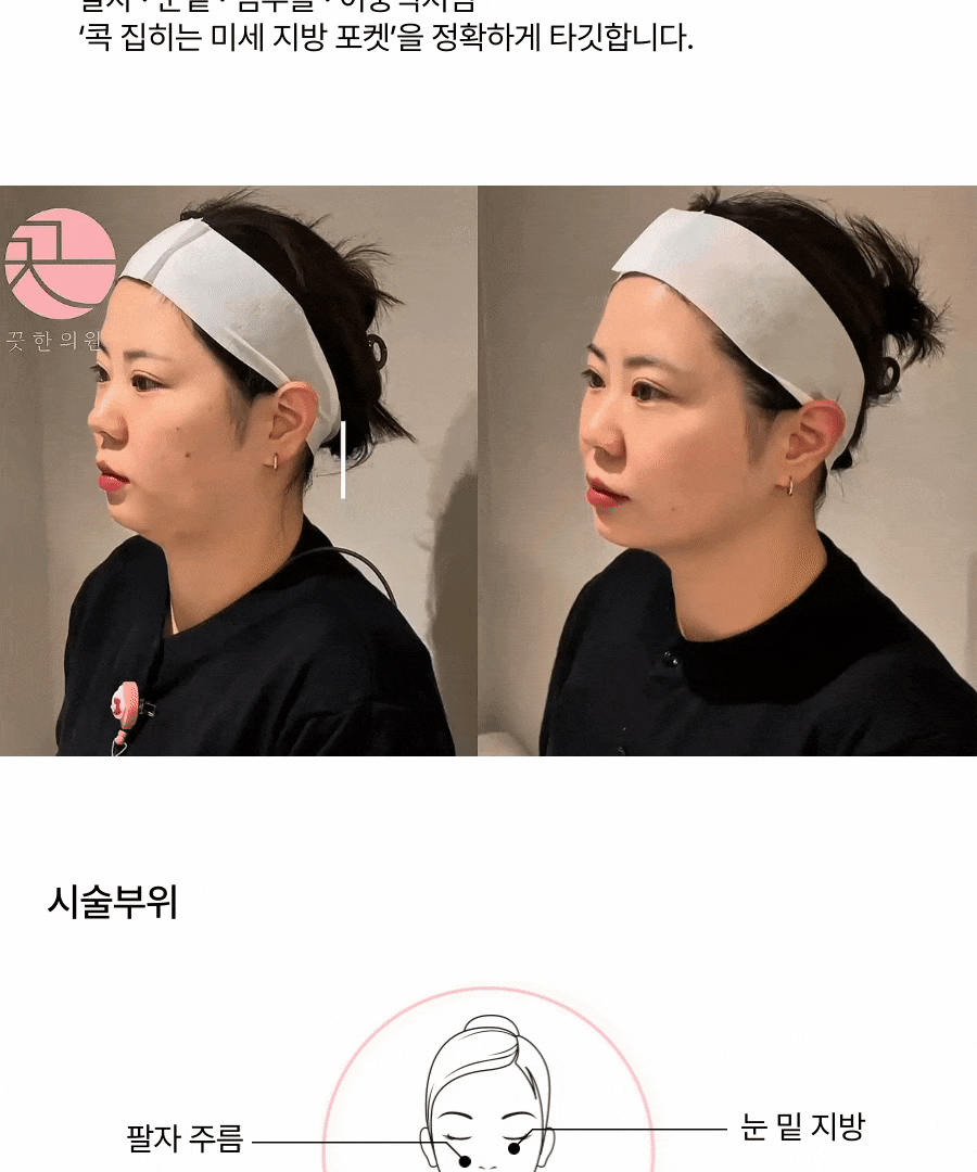  [불독살 지방 제거를 비수술로] 심부볼(불독살) 지방사침 상세 이미지