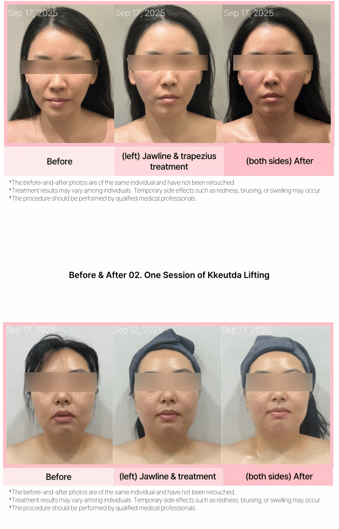 คึดตะลิฟติ้ง (Kkeutda Lifting) ด้วยไมโครเวฟ 상세 이미지