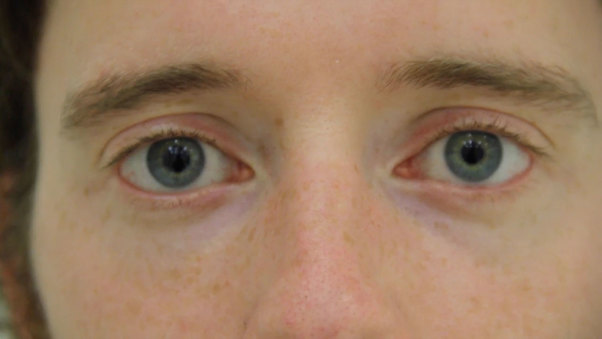 Blindness 2 Sight