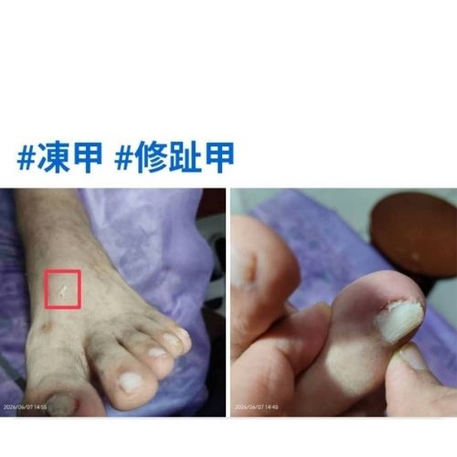 修趾甲/凍甲/卷甲/厚甲