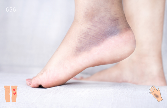 Protein Electrophoresis, Serum Test