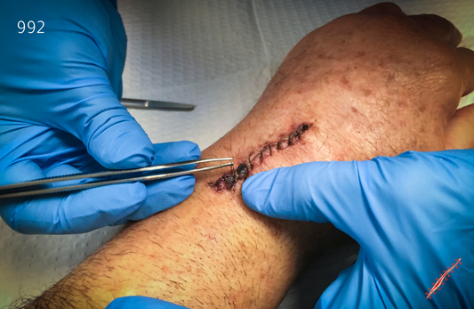 ازالة الغرز في المنزل