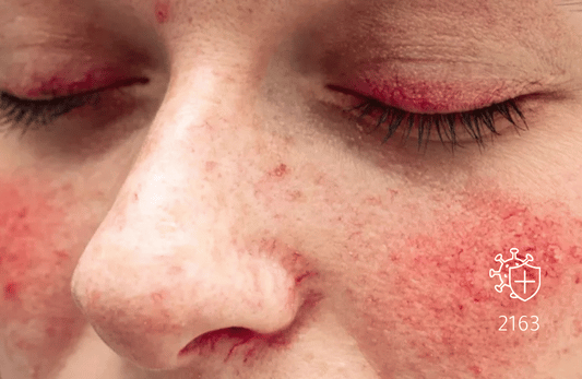 مضادات الهيستون