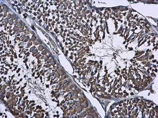 Immunohistochemistry: Wilms Tumour Protein