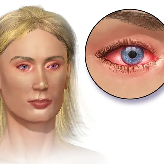 Culture & Sensitivity - Eye Swab