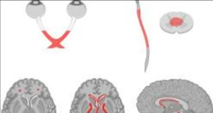 Neuromyelitis Optica (NMO) AQp4 Anti-bodies IgG