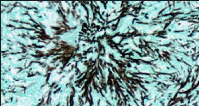 Special Stain: Grocott Methenamine Silver (GMS)