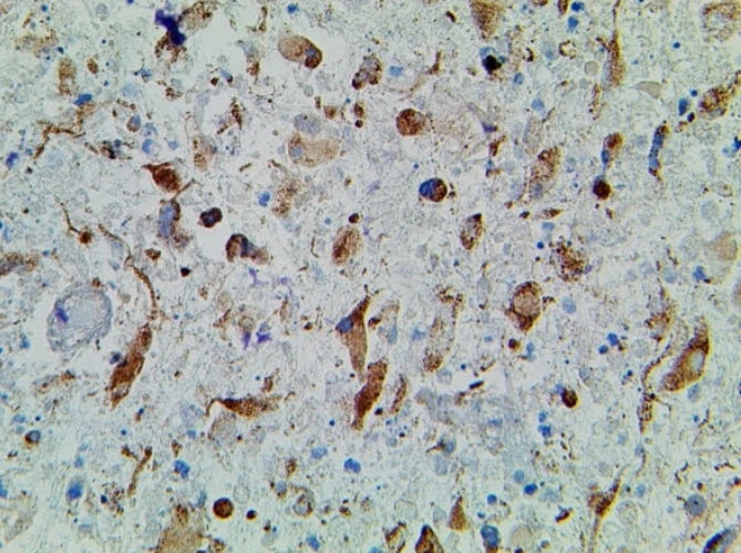 Immunohistochemistry: IDH1