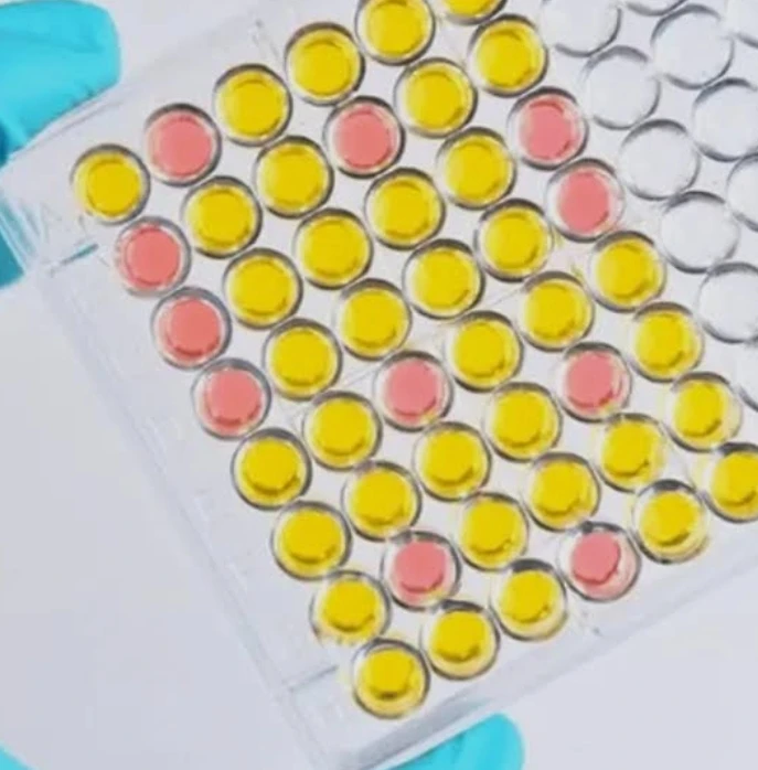 Human Immunodeficiency Virus (HIV), Western Blot