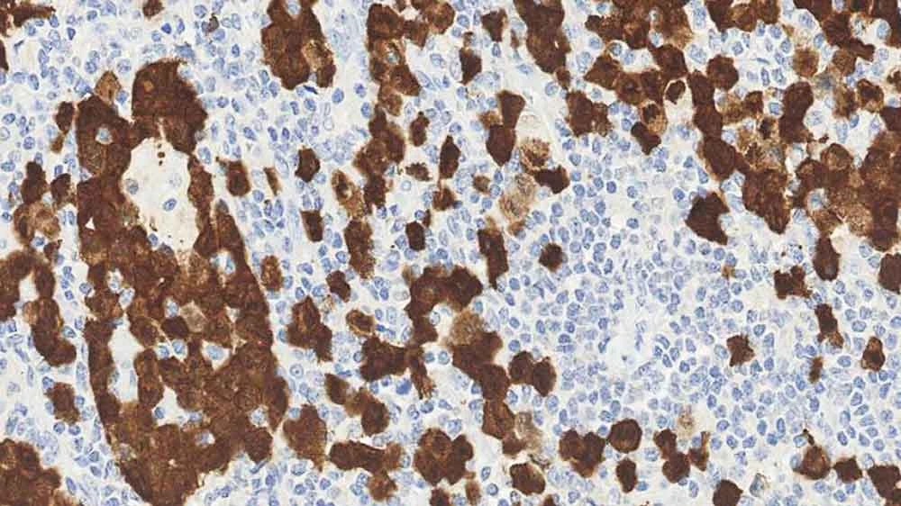 Immunohistochemistry: ALK Lymphoma