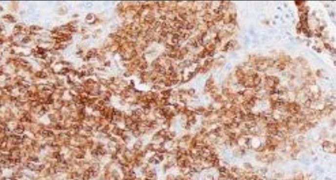Immunohistochemistry: CD45 (Leukocyte Common Ag)