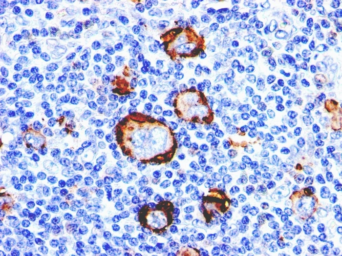 Immunohistochemistry: CD15 (Reed-Sternberg Cells)