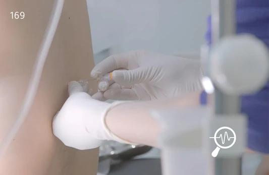 Angiotensin Converting Enzyme in Cerebrospinal Fluid, CSF Test