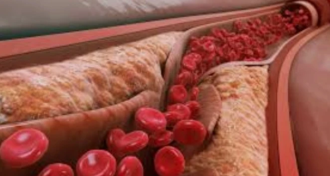 Very Low-Density Lipoprotein (VLDL)