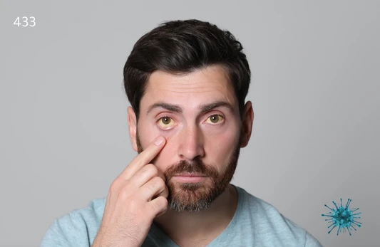 تحليل فيروس التهاب الكبد A الكلي