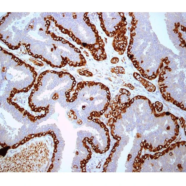 Immunohistochemistry: Interpretation and Consultation (6 Marker)
