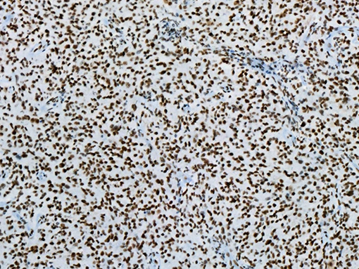 Immunohistochemistry: Calritinin