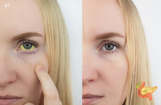 Bilirubin (Direct) Test