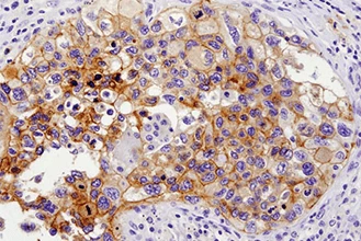 Immunohistochemistry: Interpretation and Consultation (2 Marker)