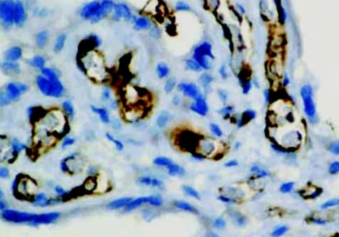 Immunohistochemistry: Factor VIII