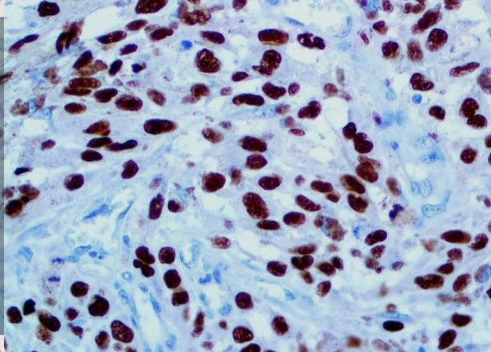 Immunohistochemistry: SOX10